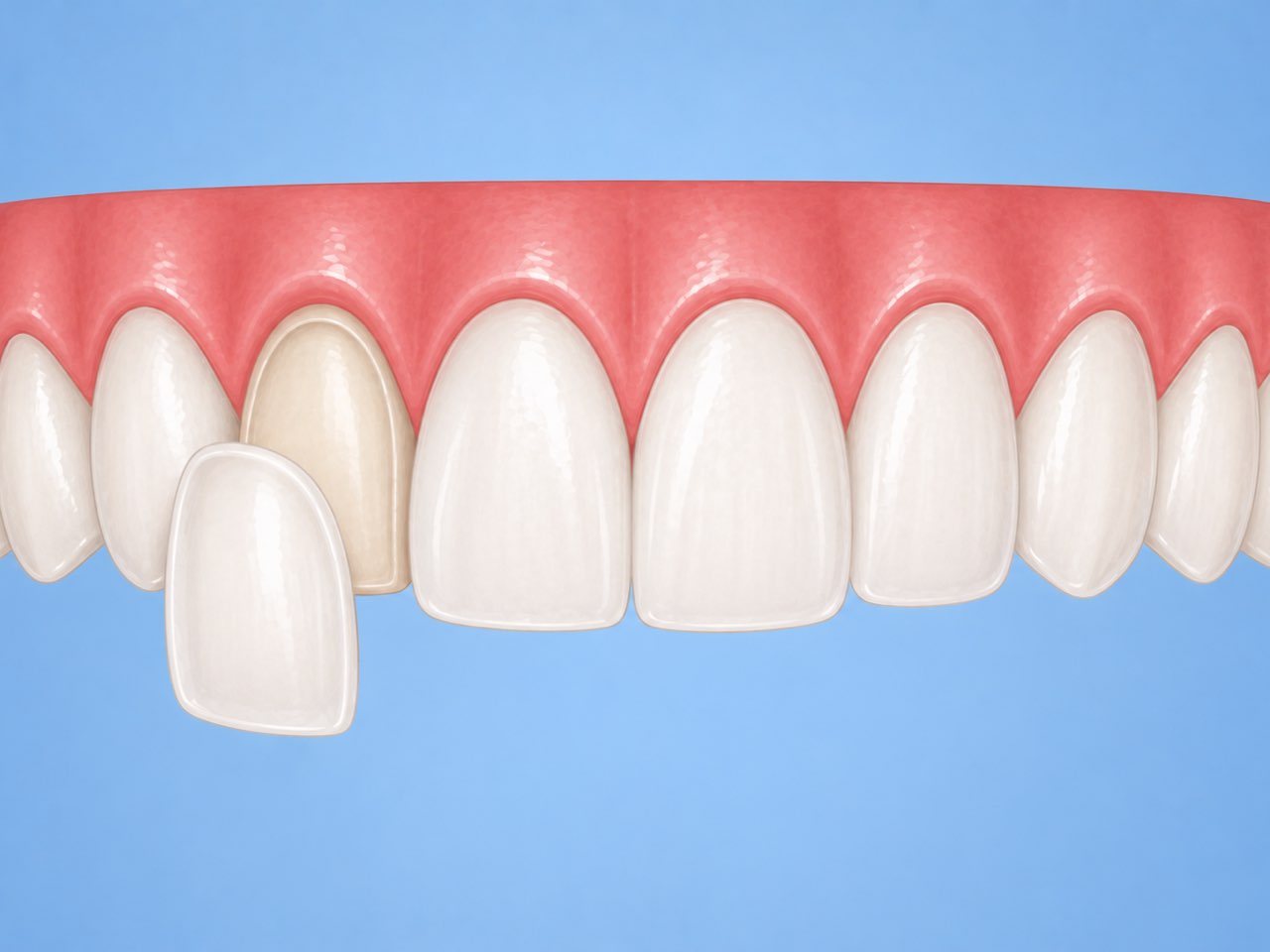 A veneer held against an upper front tooth, next to the neighbouring teeth it has to match